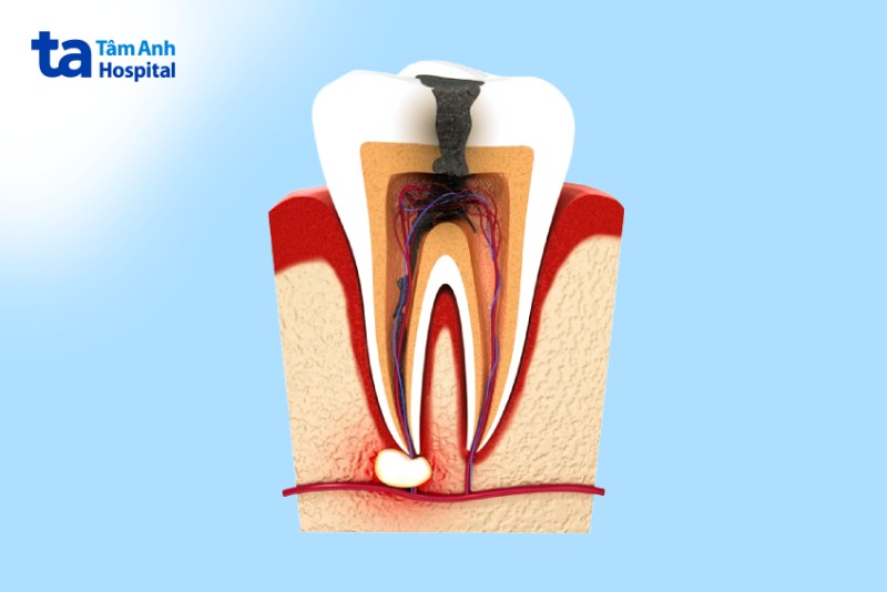 Những răng nào cần điều trị tủy răng?