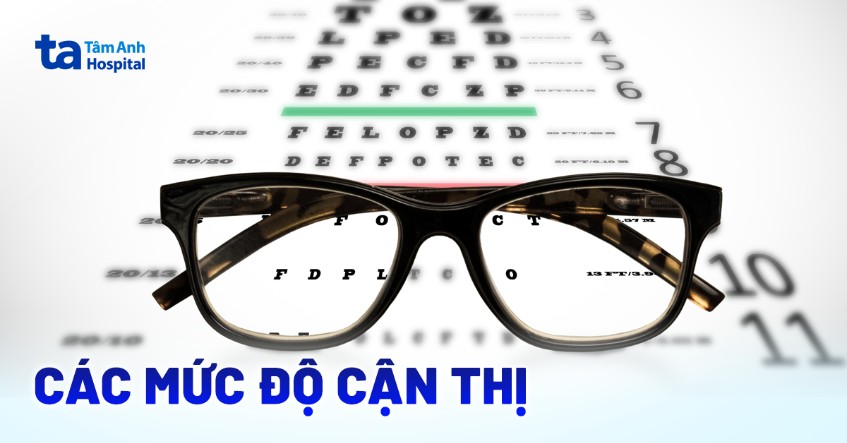 Các mức độ cận thị của mắt: cách tính, yếu tố rủi ro và chẩn đoán