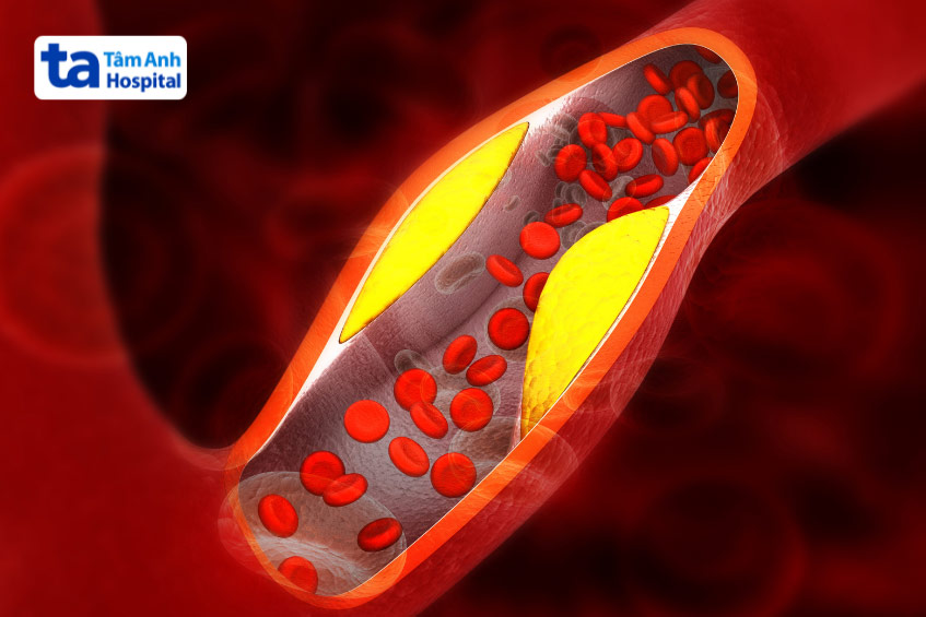 Hình ảnh minh họa động mạch bị hẹp do các mảng cholesterol bám vào thành động mạch gây giảm dòng máu đi qua