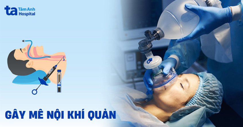 Gây mê nội khí quản là gì? Vai trò, chỉ định, rủi ro và quy trình