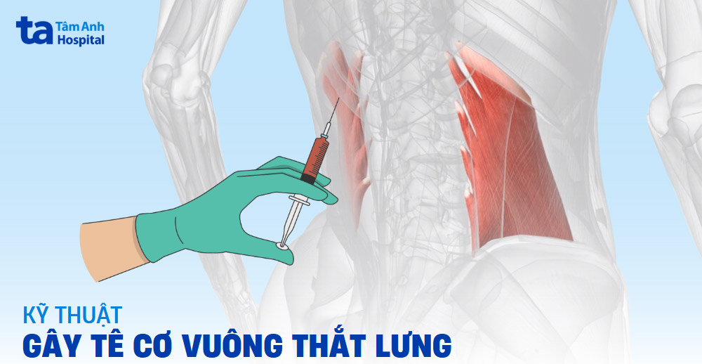 Kỹ thuật gây tê cơ vuông thắt lưng: Ưu điểm, chỉ định và quy trình