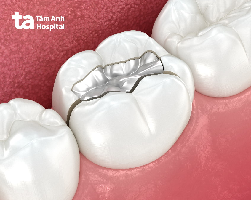 Các vật liệu hàn răng thông dụng, Hàn răng bằng Amalgam