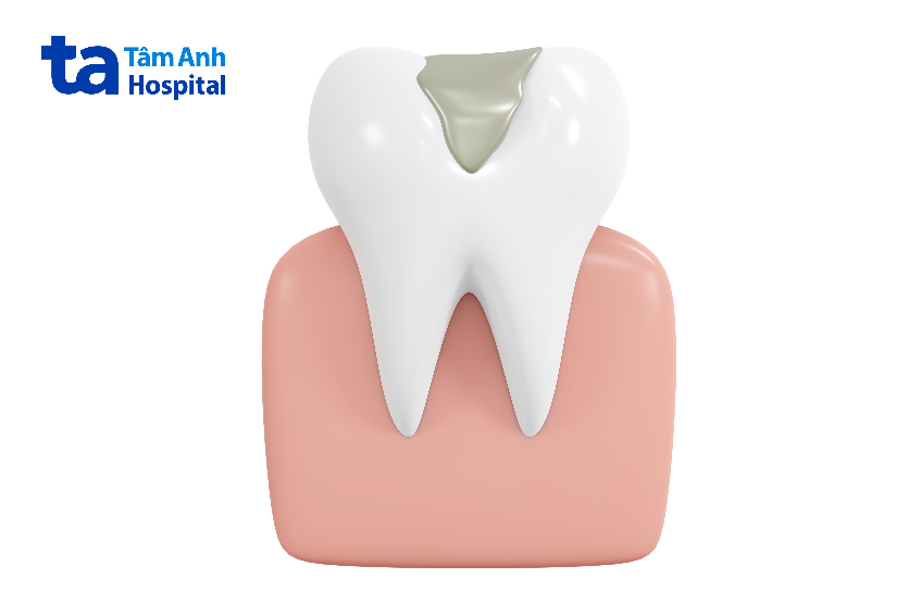 Hàn răng bằng titan hoặc vàng