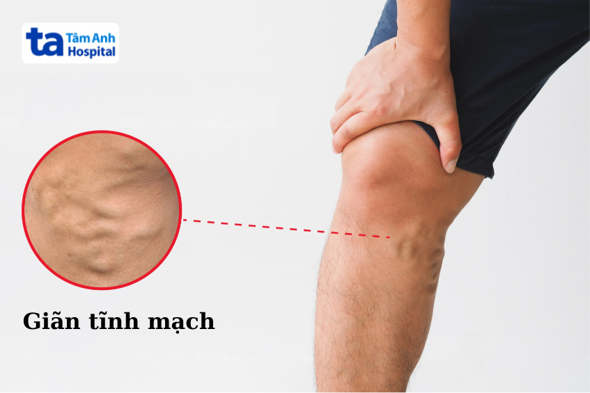 Hình ảnh bệnh nhân bị giãn tĩnh mạch ở chân