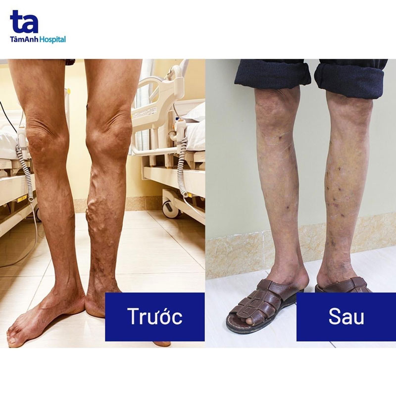 Hình ảnh chân bệnh nhân trước và sau phẫu thuật giãn tĩnh mạch