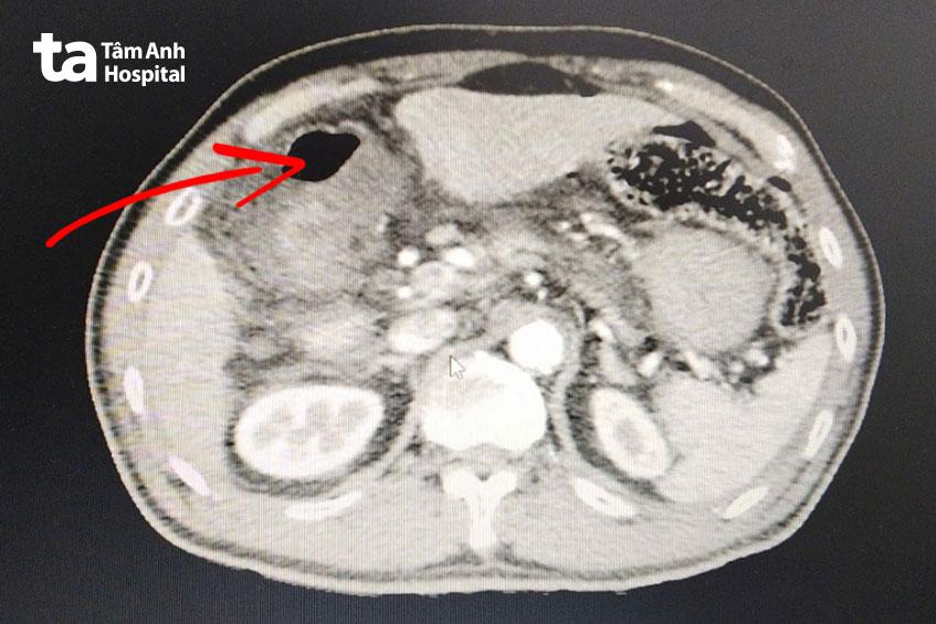 hình ảnh chụp ct thấy dịch