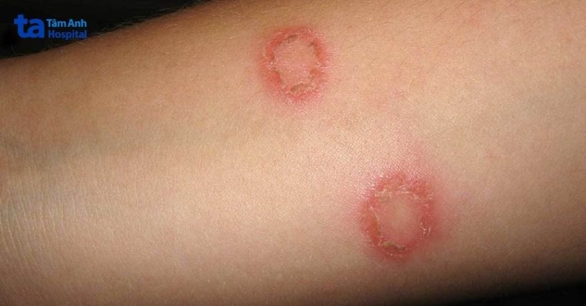 hình ảnh da nổi đốm đỏ
