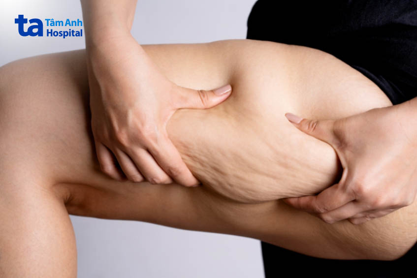 hình ảnh da sần vỏ cam ở đùi