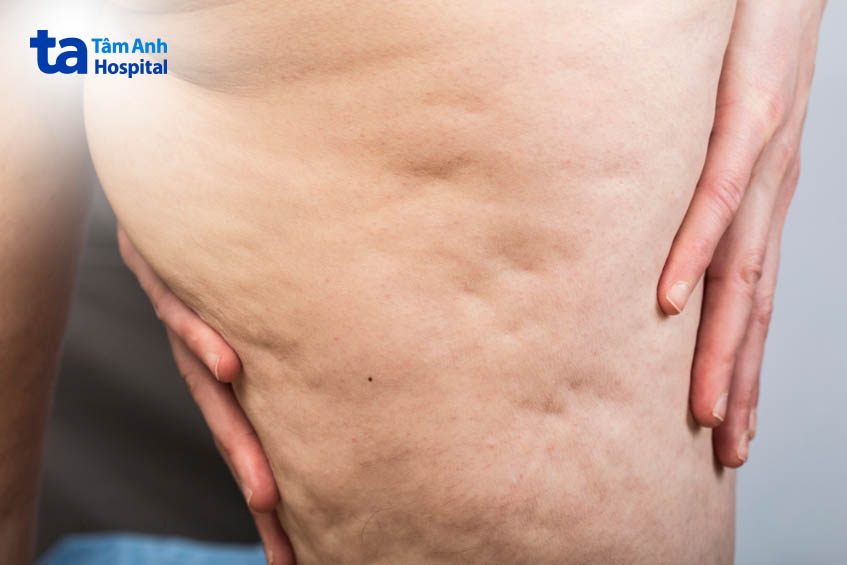 hình ảnh da sần vỏ cam thực tế