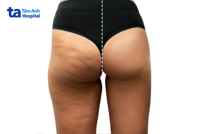 hình ảnh da sần vỏ cam vùng mông