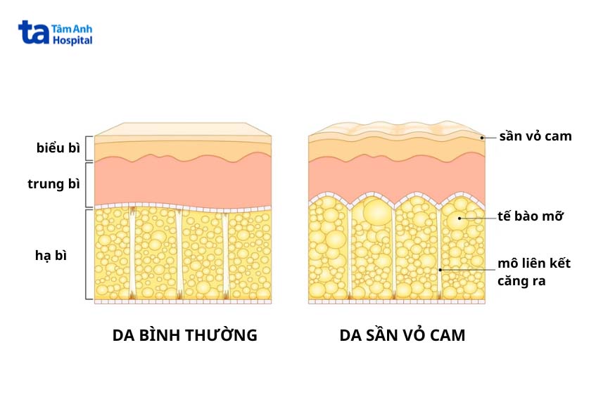 Hình ảnh da thường và da bị sần sùi vỏ cam