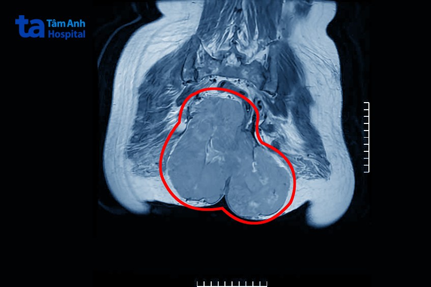hình ảnh khối u sarcoma