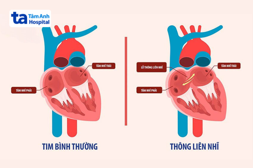 Hình ảnh minh họa tim bị dị tật bẩm sinh thông liên nhĩ