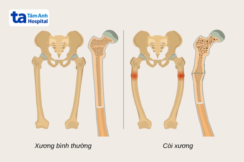 Hình ảnh minh họa xương bình thường và tình trạng còi xương