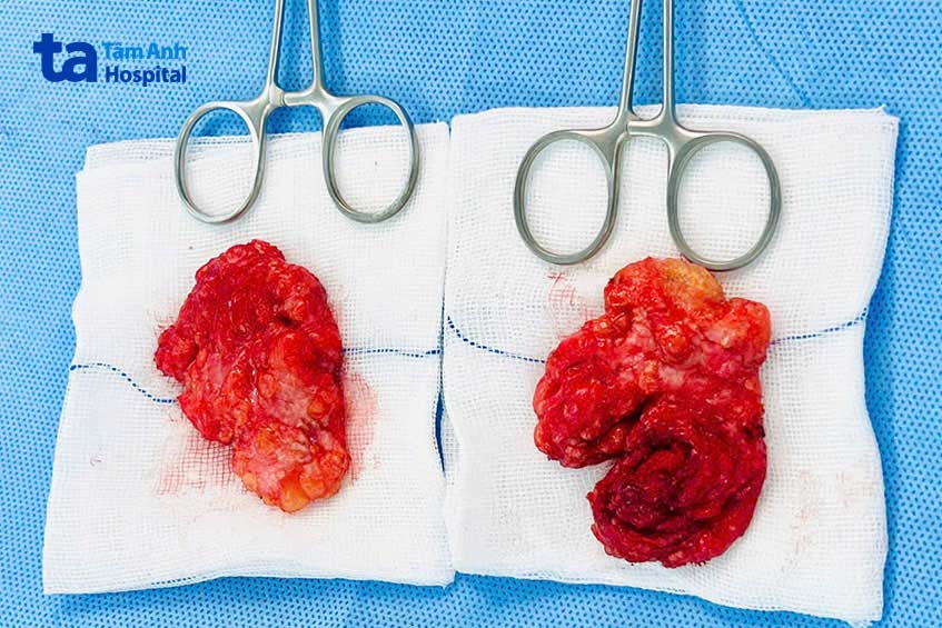 Hình ảnh mô tuyến vú hai bên của người bệnh được được bóc tách sau cuộc phẫu thuật