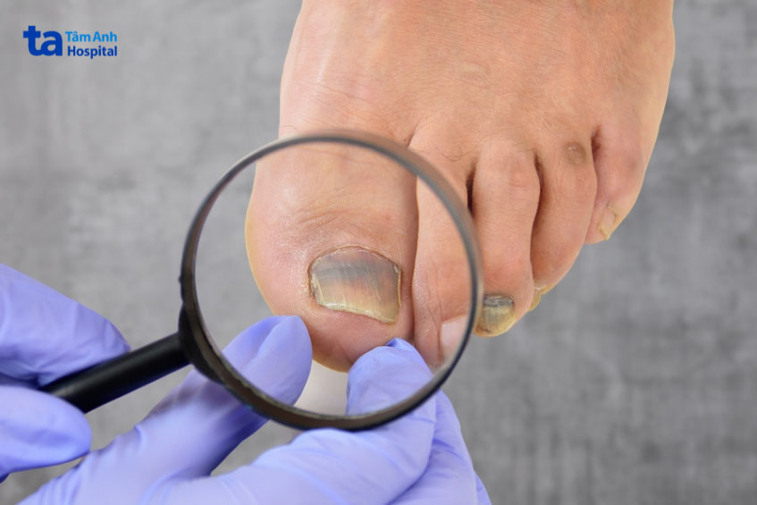 Hình ảnh móng chân bị nấm