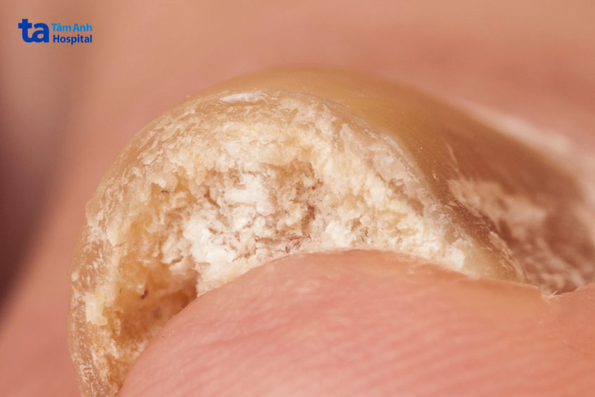 Hình sừng móng ngón chân