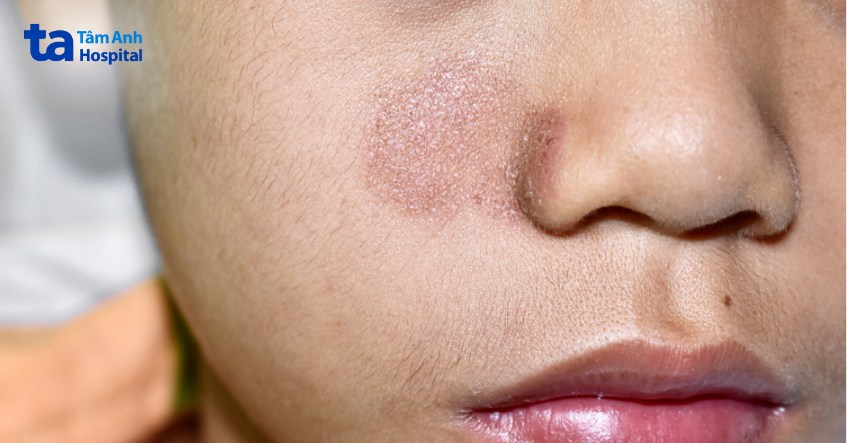 hình ảnh nhận biết nấm da mặt