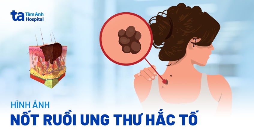 Hình ảnh nốt ruồi ung thư hắc tố dễ nhận biết, đừng chủ quan