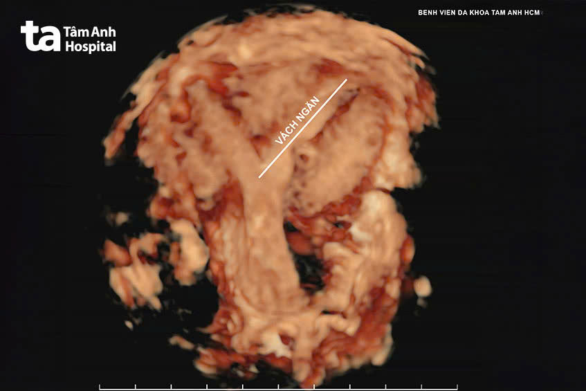 hình ảnh siêu âm vách ngăn tử cung chia đôi