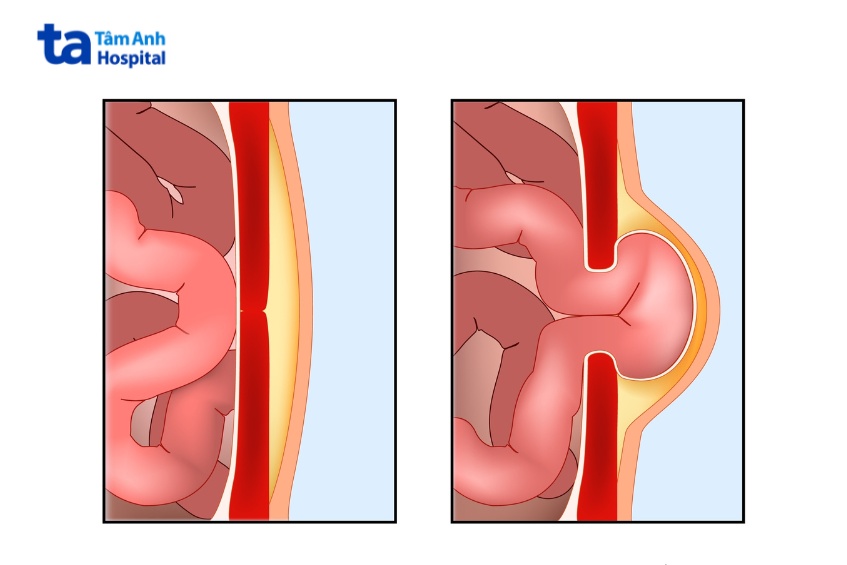 Hình ảnh thành bụng bình thường và thoát vị thành bụng