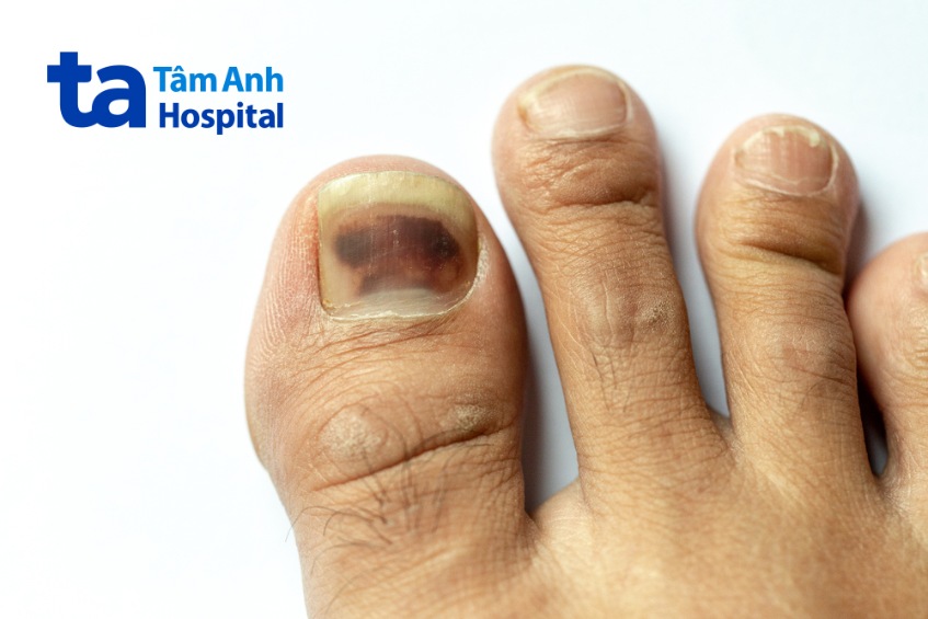 hình ảnh ung thư hắc tố dưới móng chân