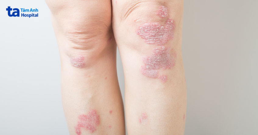 hình ảnh viêm da cơ địa ở chân