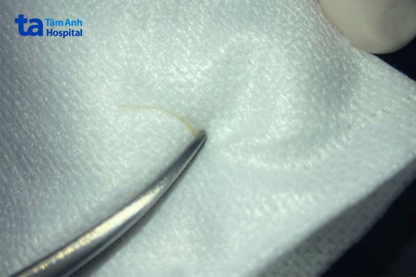 hình ảnh xương cá 5cm