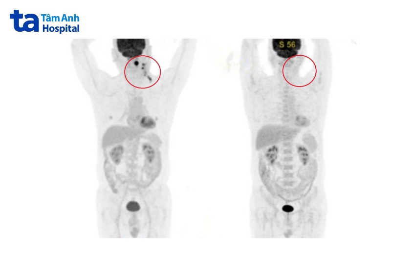 hình chụp ung thư sau điều trị cho thấy hạch tan hoàn toàn