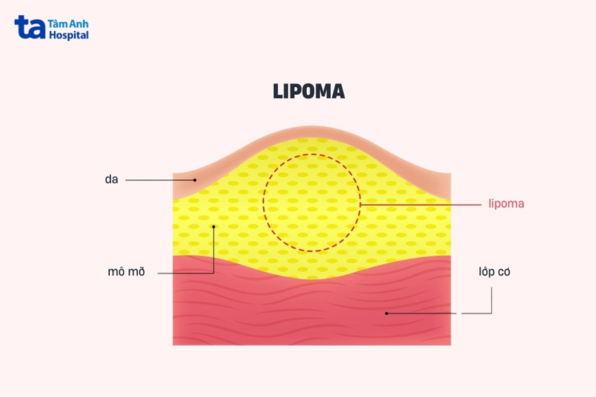 hình thành do tế bào mỡ phát triển quá mức