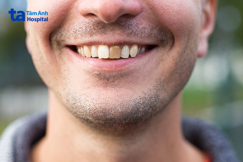 Hoại tử tủy răng là gì?