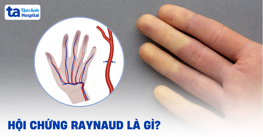 hội chứng raynaud