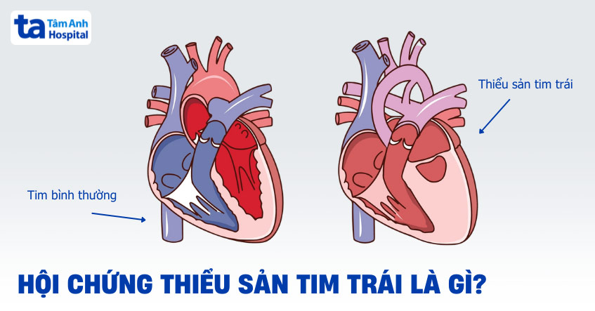 Hội chứng thiểu sản tim trái (HLHS)