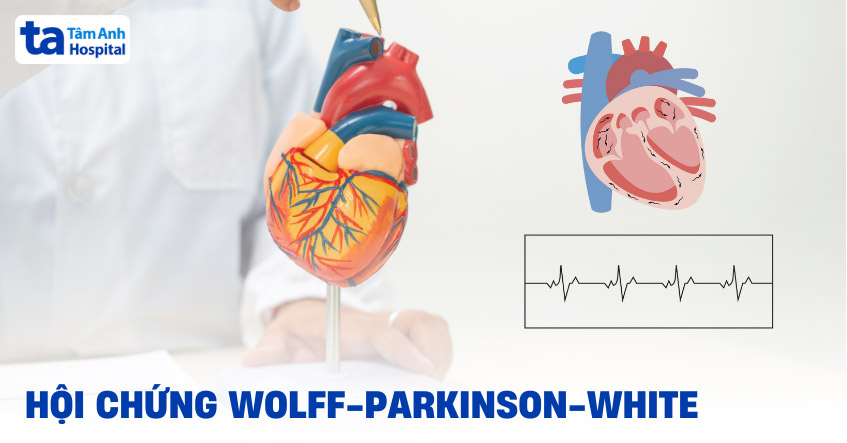 Hội chứng Wolff-Parkinson-White (WPW)