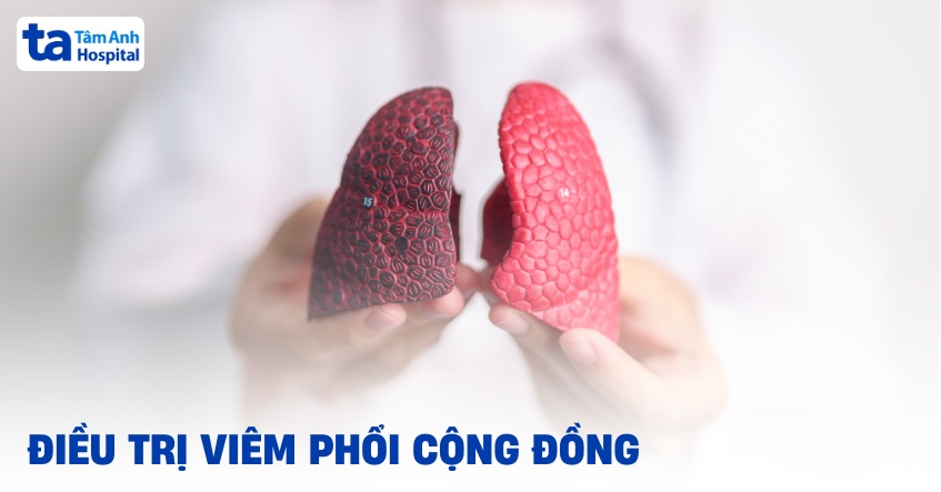 Hướng dẫn điều trị viêm phổi cộng đồng và 7 cách chẩn đoán bệnh