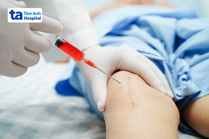 Hút lấy dịch khớp chẩn đoán lý do sưng đầu gối