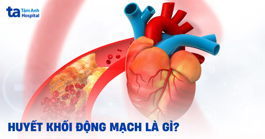 Huyết khối động mạch: Nguyên nhân, triệu chứng, chẩn đoán, điều trị