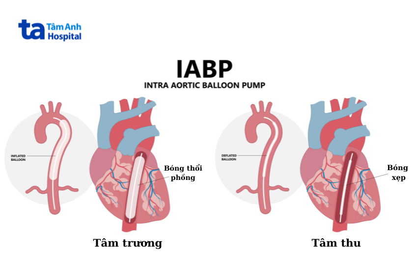 IABP được đồng bộ hóa chính xác với chu kỳ tim đập