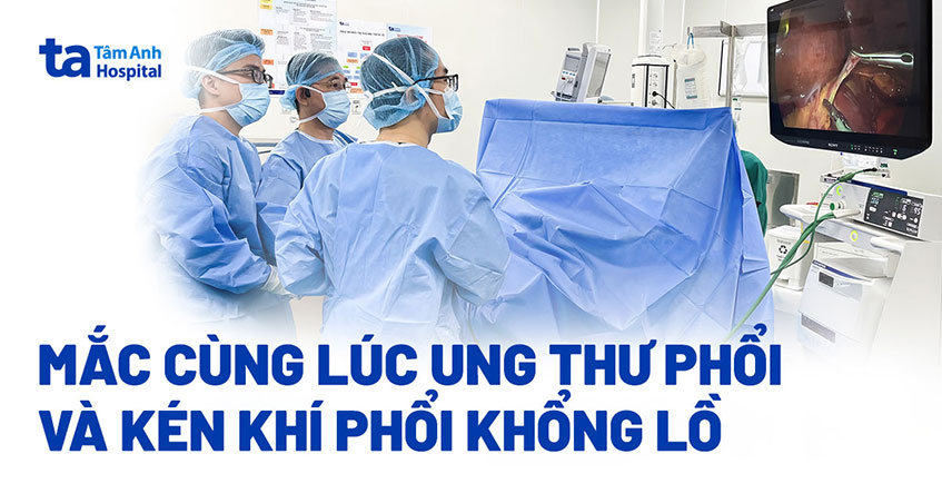 Kén khí phổi khổng lồ ở người đàn ông nghiện thuốc lá