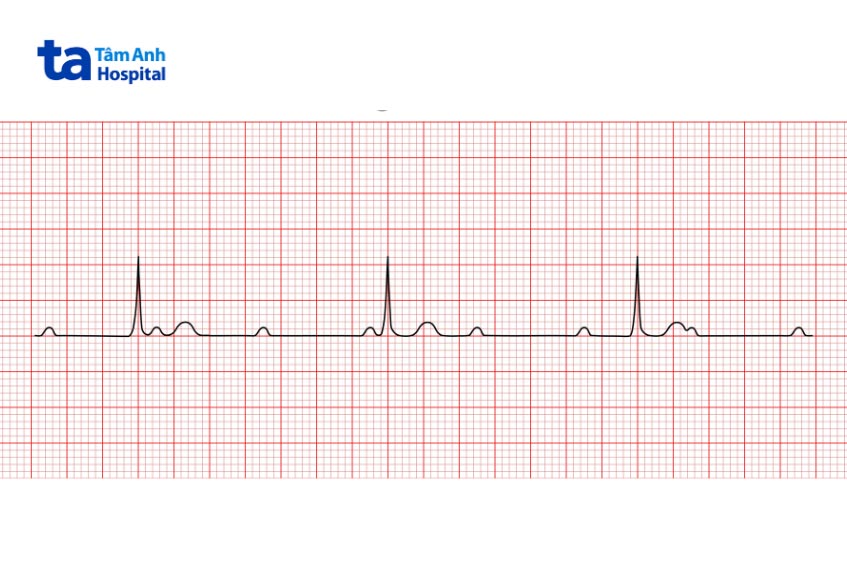 Kết quả ECG biểu hiện bệnh nhân đang mắc block nhĩ thất độ 3