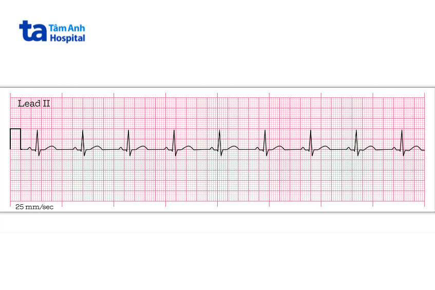 Kết quả ECG hiển thị bệnh nhân có nhịp xoang bình thường