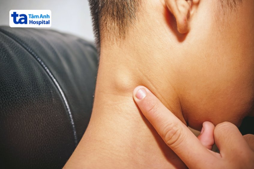 Khi phát hiện trẻ nổi hạch, bố mẹ nên đưa trẻ đến bệnh viện