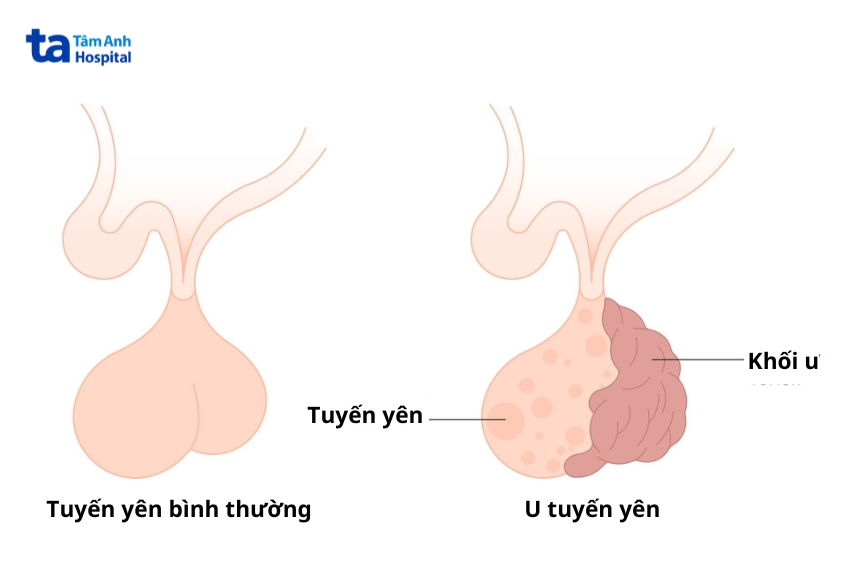 Khối u có thể ảnh hưởng đến chức năng tuyến yên