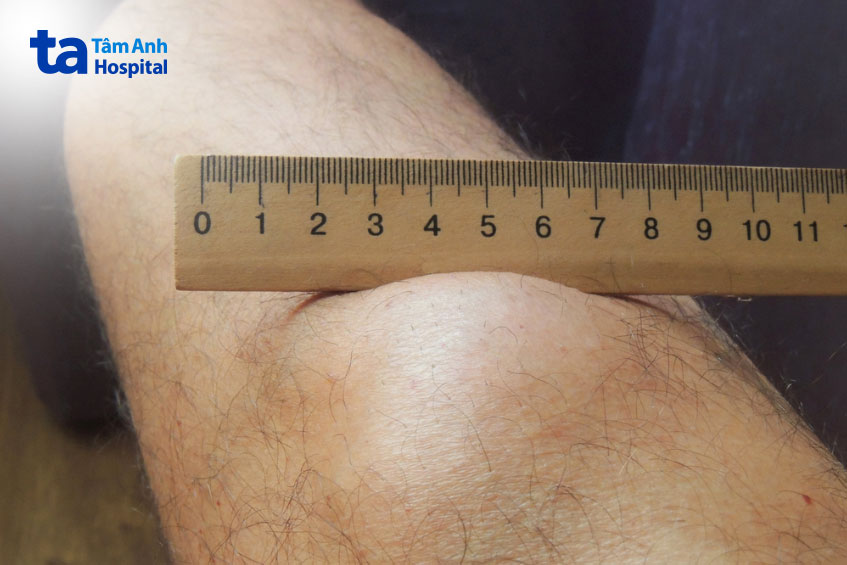 khối u có thể phát triển rất to