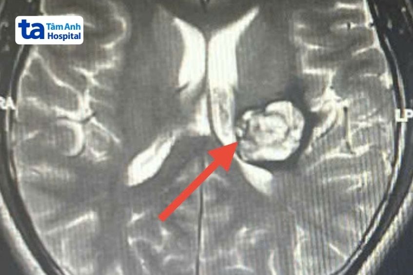 khối u mạch máu thể hang qua chụp chiếu