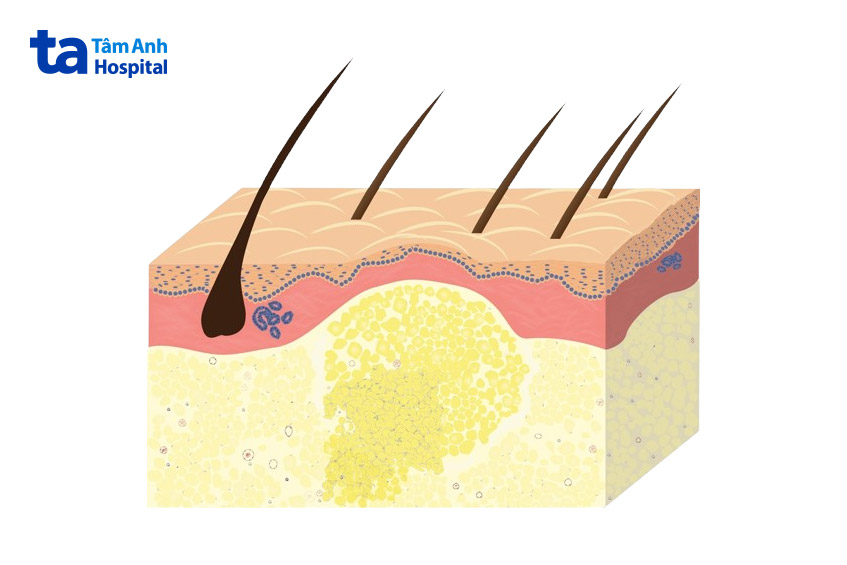 khối u mỡ phát triển ngay bên dưới da