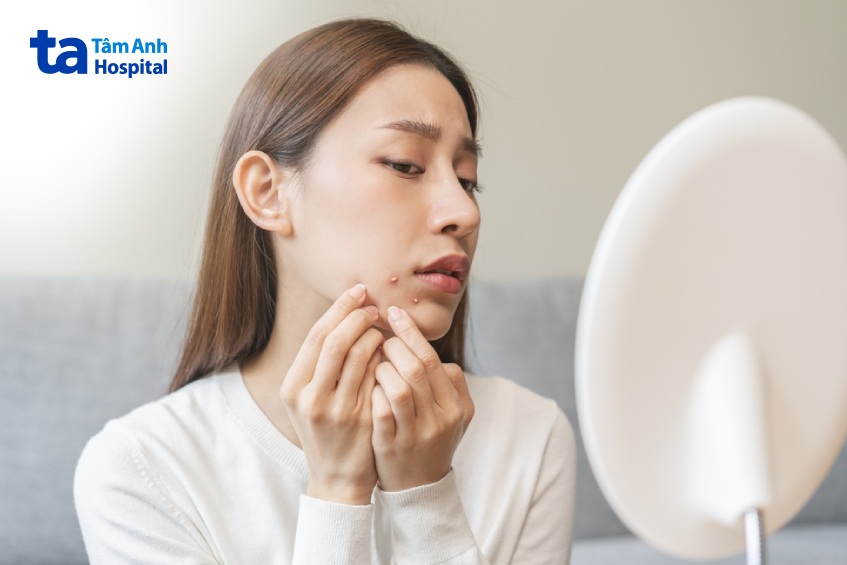 không chạm hoặc nặn mụn nhọt