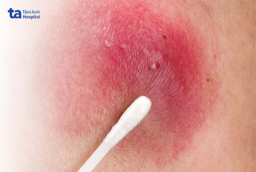 không nên nặn mụn nhọt khi chưa có mủ