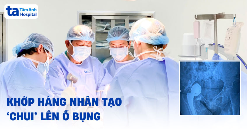 Hi hữu: Khớp háng nhân tạo “chui” vào ổ bụng