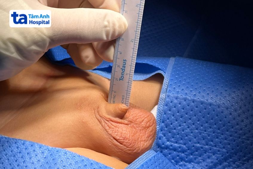 Kiểm tra, định hình kích thước, chiều dài dương vật